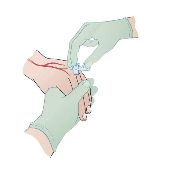 Cannulation Insertion