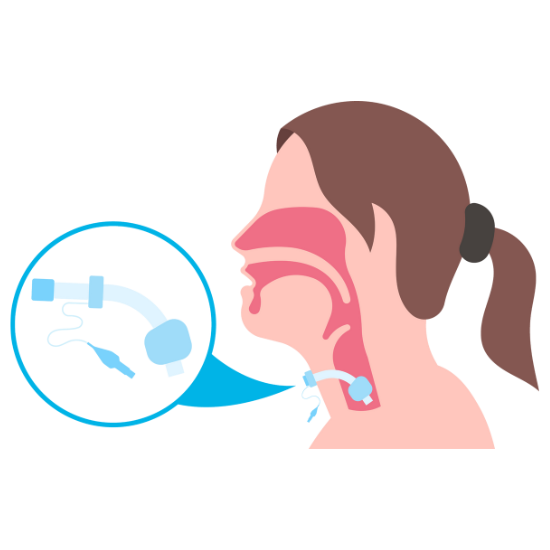 Tracheostomy Tube Change